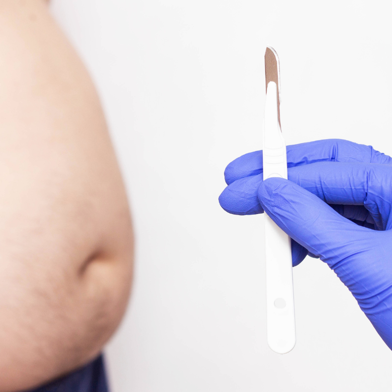 Cirugía de Manga Gástrica